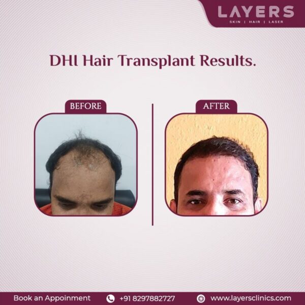 Layers, A Hair Transplant Clinic in Hyderabad, Implements Direct Hair Implantation (DHI) To Help Its Clients Tackle Premature Baldness