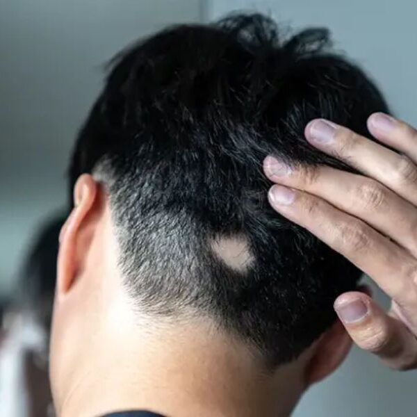 Alopecia Areata Homeopathy Treatment Offers Hope for Adults and Adolescents