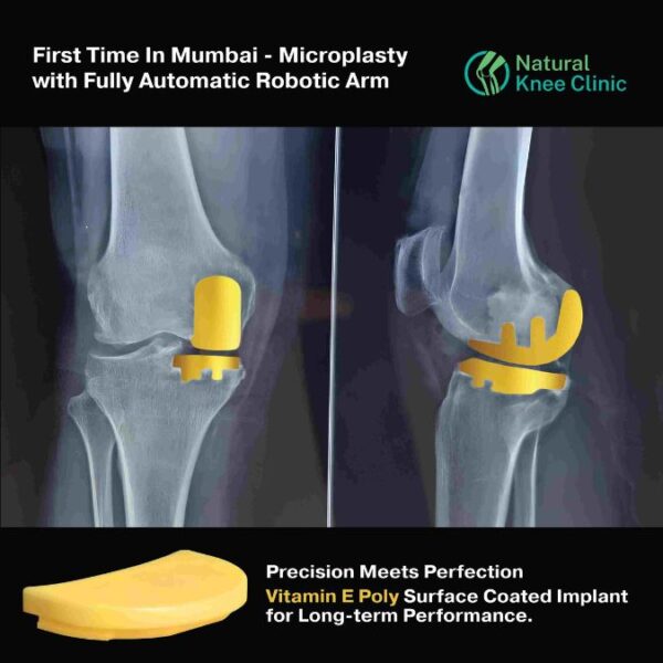 Medical Breakthrough: Preserve Your Natural Knee with Absolute Precision Robotic Microplasty Surgical Technique