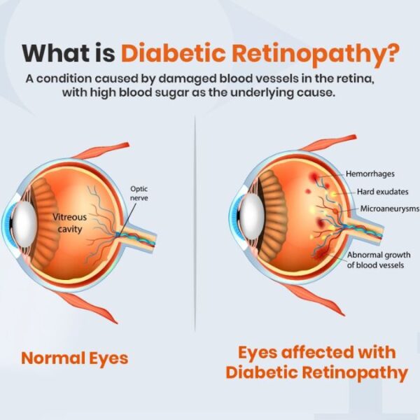 Can Diabetic Retinopathy Be Reversed?