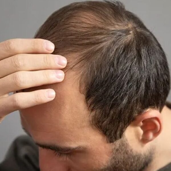 Dr Batra’s® Healthcare Introduces World’s Most Advanced Treatment for Targeted Hereditary Hair Loss: XOGEN